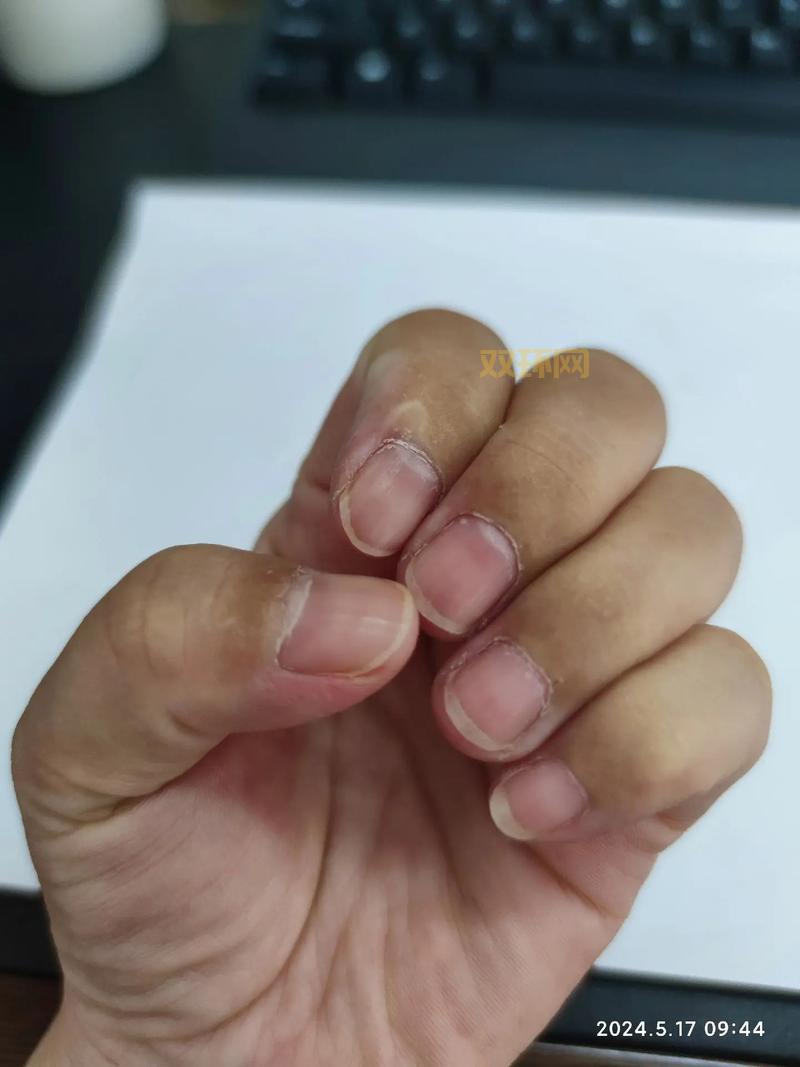 硬甲皮是什么？这几个原因你一定要知道！